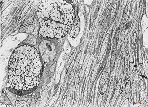 F,31y. | ovary - mucinous carcinoma